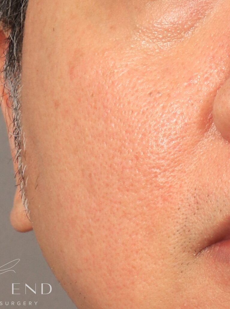 After Image: CO2 Resurfacing (2 Months Post-op) - front