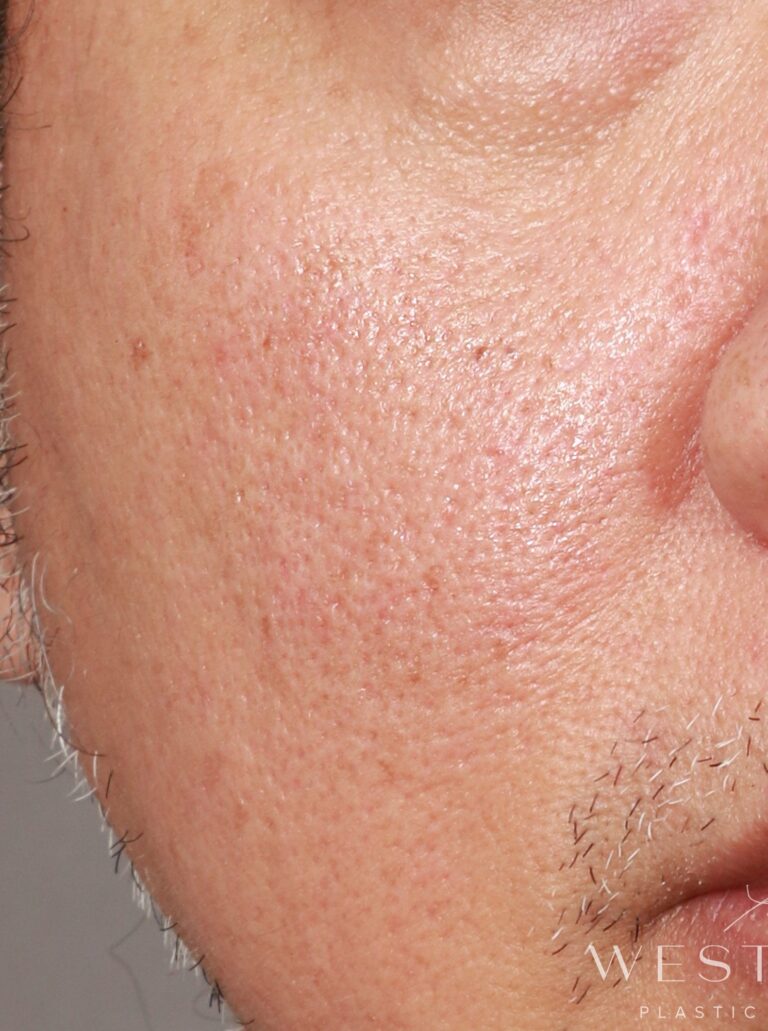 Before Image: CO2 Resurfacing (2 Months Post-op) - front