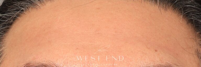 After Image: CO2 Resurfacing (2 Months Post-op) - front