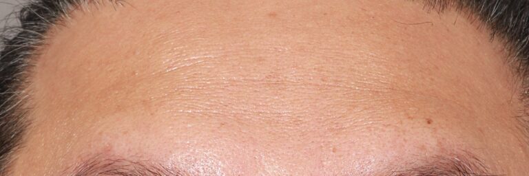 Before Image: CO2 Resurfacing (2 Months Post-op) - front