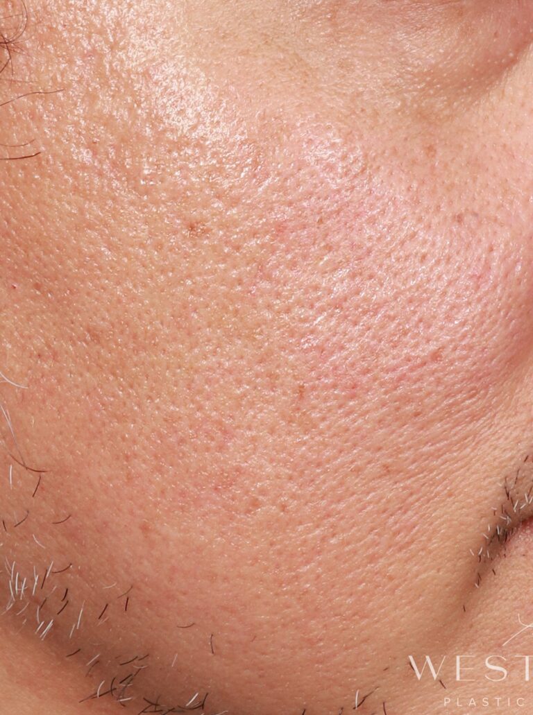 Before Image: CO2 Resurfacing (2 Months Post-op) - right-front-oblique