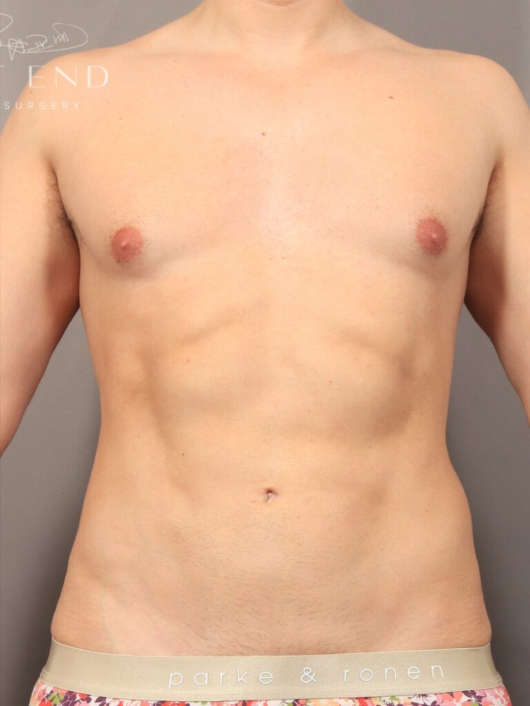 After Image: Liposuction and Renuvion Skin Tightening (1 Year Post-op) - front