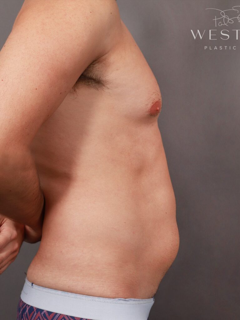 Before Image: Liposuction and Renuvion Skin Tightening (1 Year Post-op) - right-side
