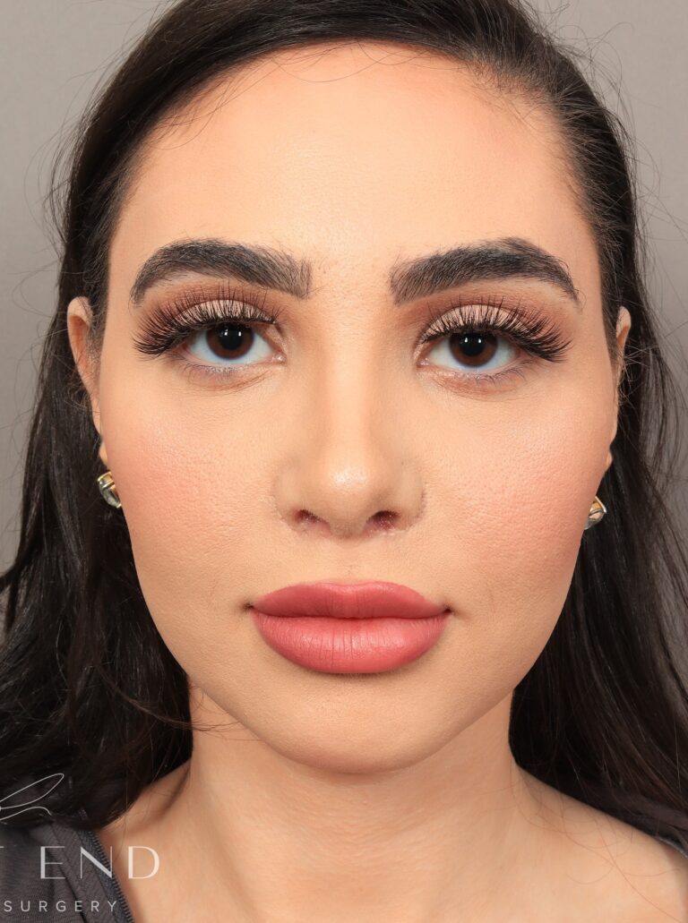 After Image: Rhinoplasty & Facial Fat Grafting (18 Days Post-op) - front