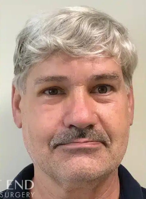 After Image: Brow Lift - front