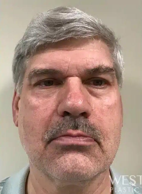 Before Image: Brow Lift - front