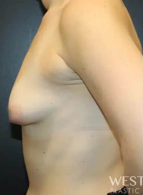 Before Image: Breast Augmentation - left-side