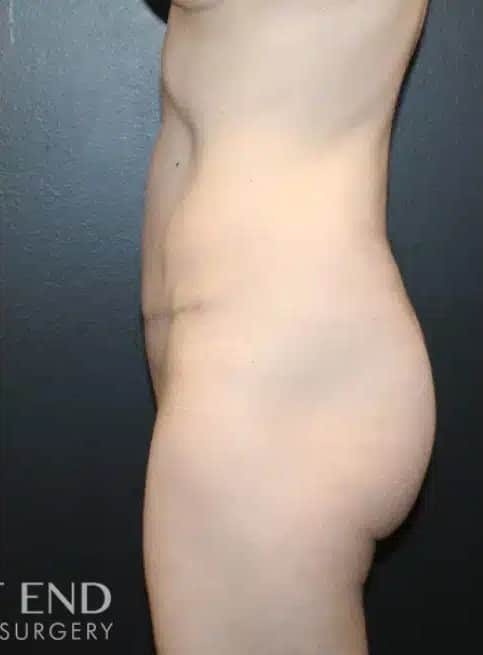 After Image: Tummy Tuck - left-side