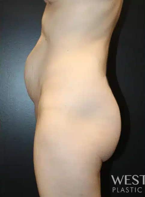 Before Image: Tummy Tuck - left-side