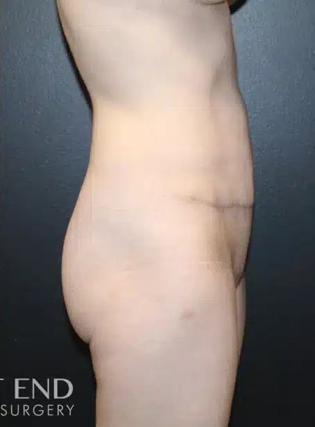 After Image: Tummy Tuck - right-side