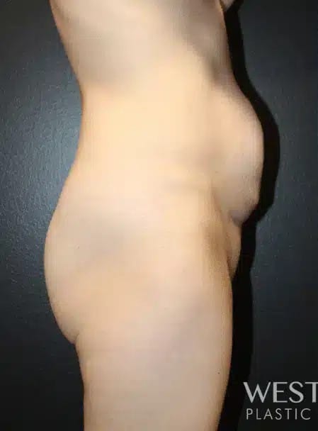 Before Image: Tummy Tuck - right-side