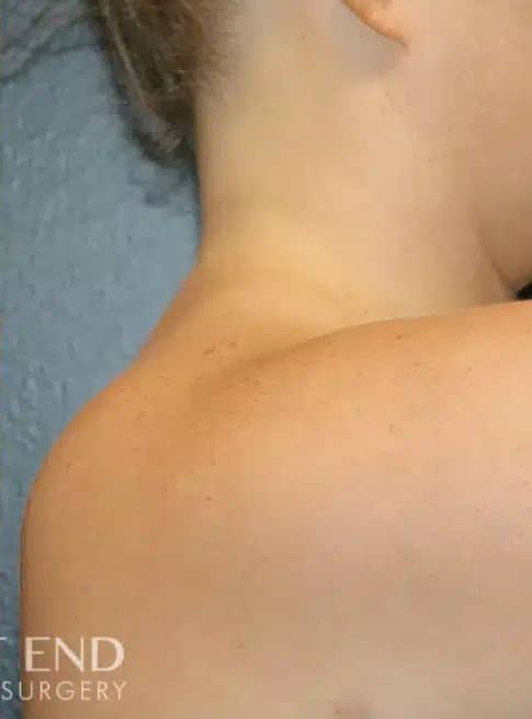 After Image: Liposuction - right-side