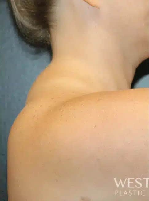 Before Image: Liposuction - right-side