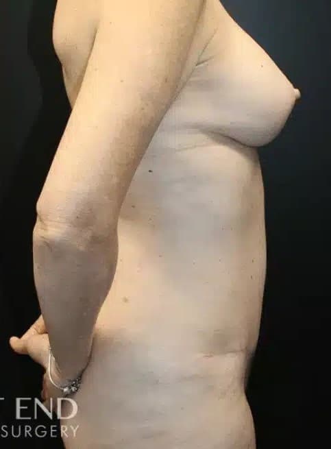 After Image: Mommy Makeover (Tummy Tuck & Breast Augmentation) - right-side