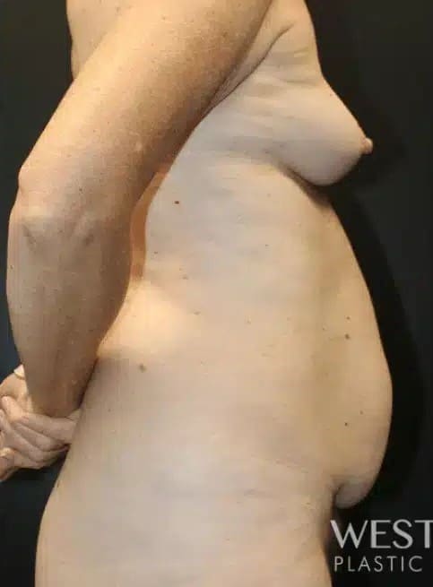 Before Image: Mommy Makeover (Tummy Tuck & Breast Augmentation) - right-side