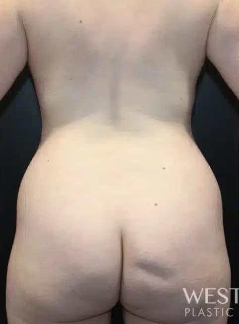 Before Image: Cosmetic Fat Transfer - back