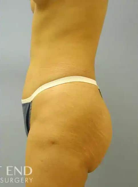 After Image: Brazilian Butt Lift - other