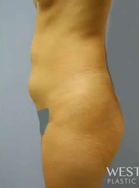 Before Image: Brazilian Butt Lift - other