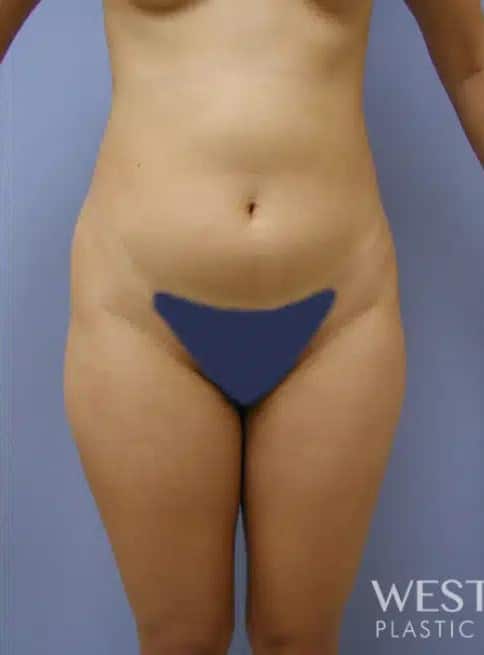 Before Image: Brazilian Butt Lift - front