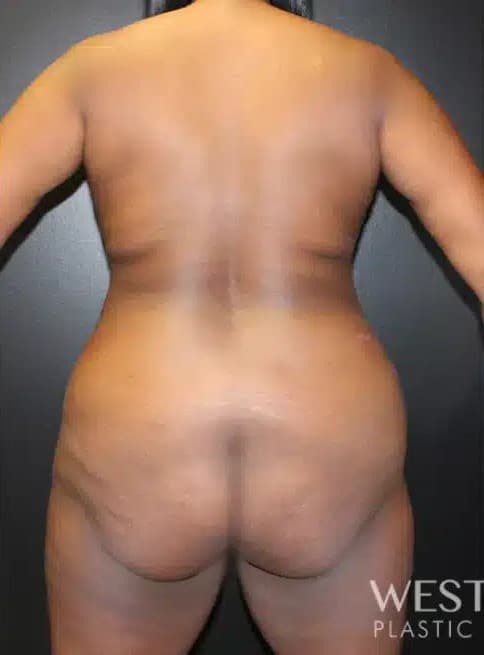 Before Image: Brazilian Butt Lift - back