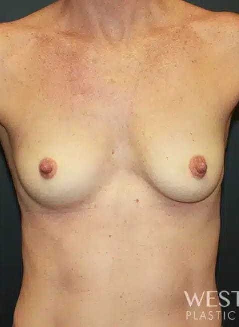 Before Image: Breast Augmentation - front
