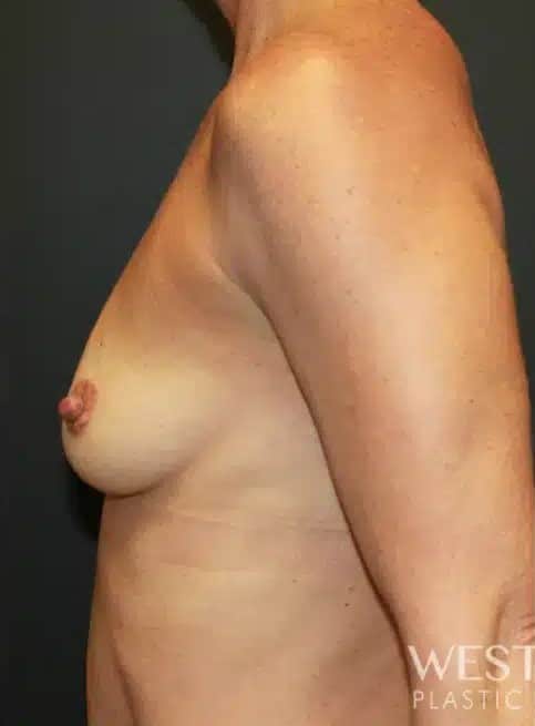 Before Image: Breast Augmentation - left-side