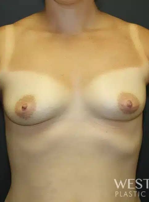 Before Image: Breast Augmentation - front