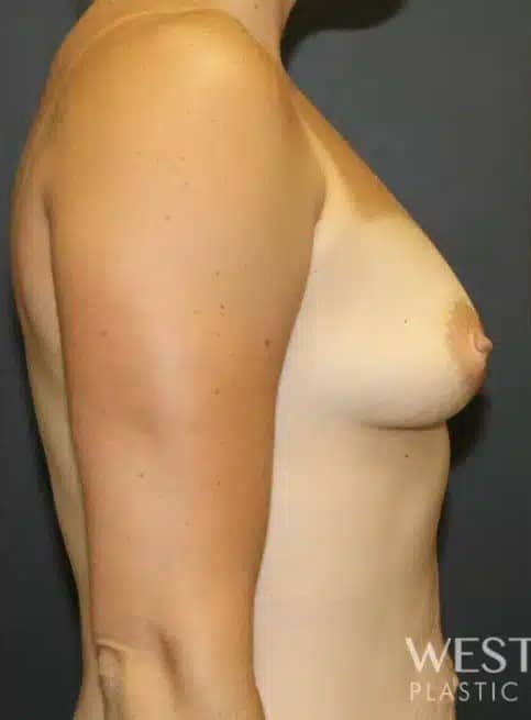 Before Image: Breast Augmentation - right-side
