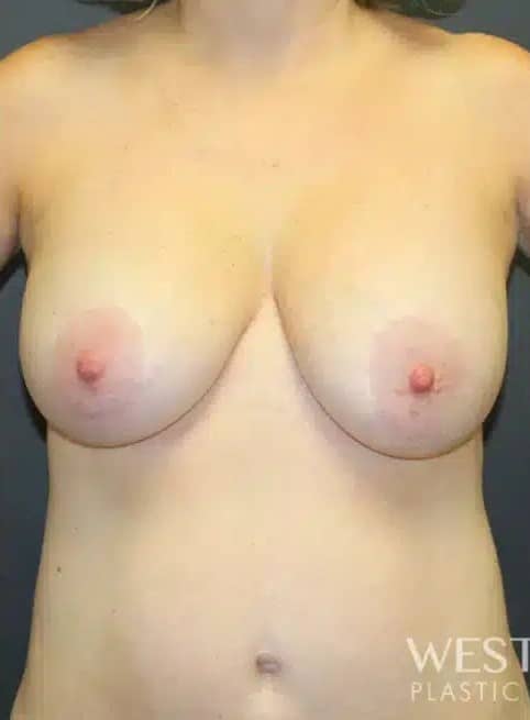 Before Image: Breast Lift - front