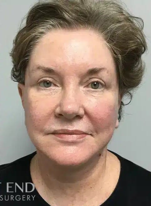 After Image: Facelift and Neck Lift - front