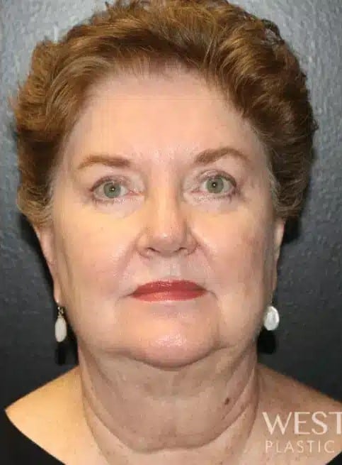 Before Image: Facelift and Neck Lift - front