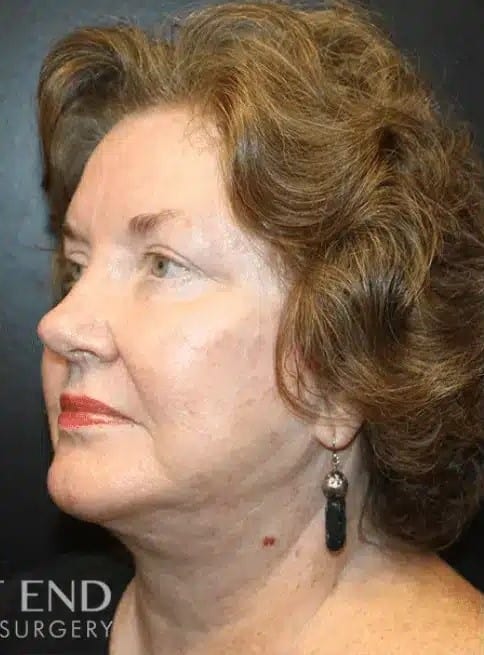 After Image: Facelift and Neck Lift - left-front-oblique