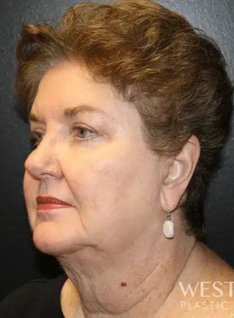 Before Image: Facelift and Neck Lift - left-front-oblique
