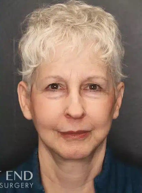 After Image: Facelift and Neck Lift - front