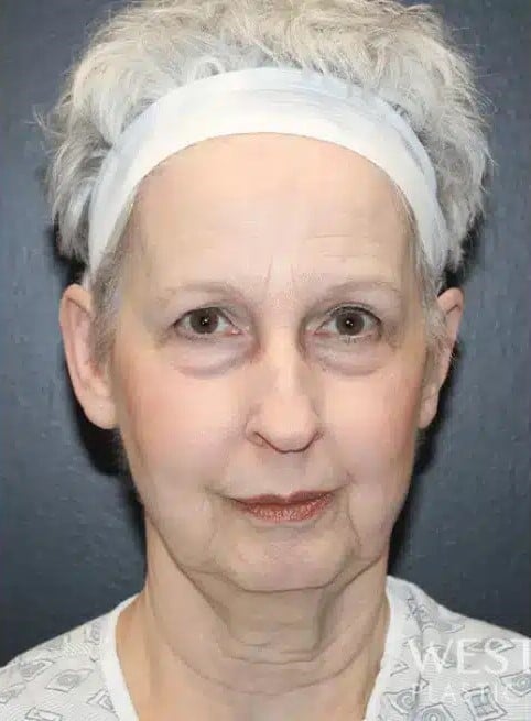 Before Image: Facelift and Neck Lift - front