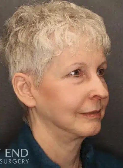 After Image: Facelift and Neck Lift - right-front-oblique