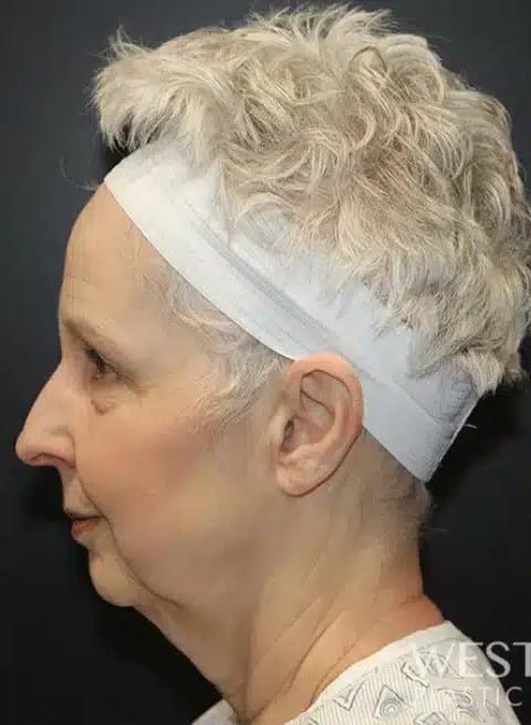 Before Image: Facelift and Neck Lift - left-side
