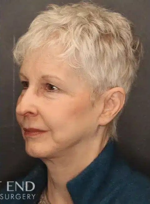 After Image: Facelift and Neck Lift - left-front-oblique