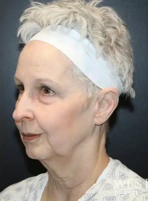 Before Image: Facelift and Neck Lift - left-front-oblique