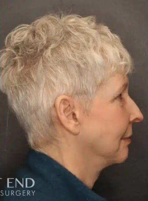 After Image: Facelift and Neck Lift - right-side