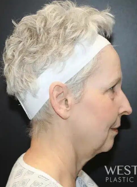 Before Image: Facelift and Neck Lift - right-side
