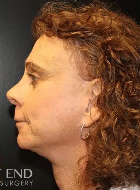 After Image: Facial Feminization Surgery - left-side