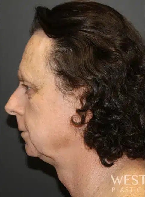 Before Image: Facial Feminization Surgery - left-side
