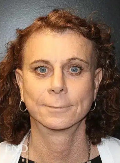 After Image: Facial Feminization Surgery - front