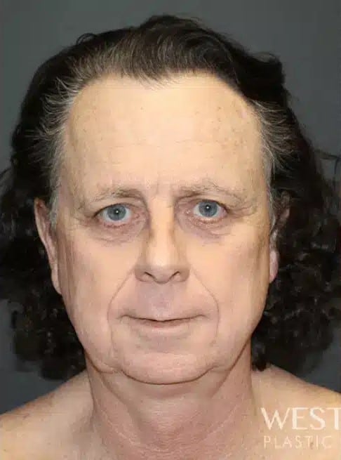 Before Image: Facial Feminization Surgery - front