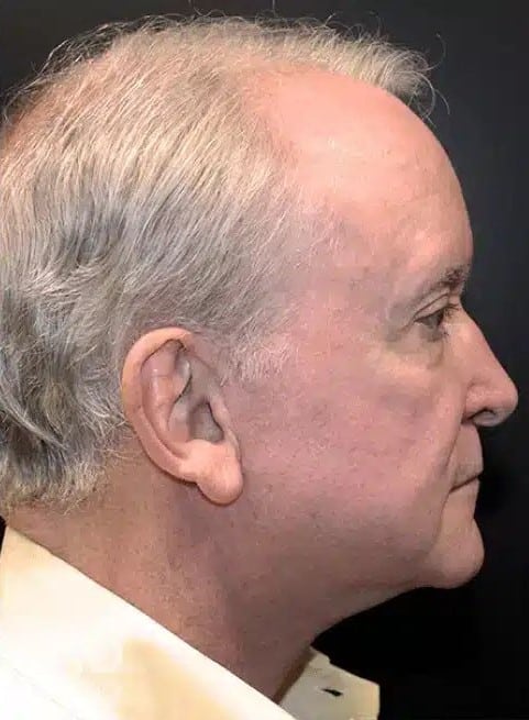 After Image: Neck Lift - right-side
