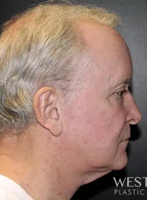 Before Image: Neck Lift - right-side
