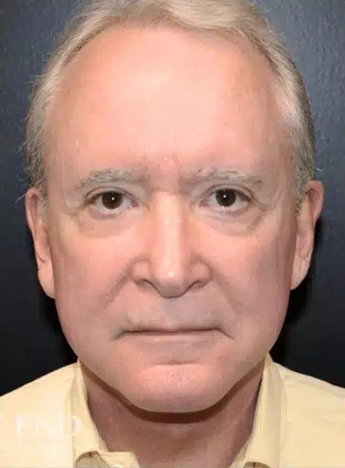 After Image: Neck Lift - front