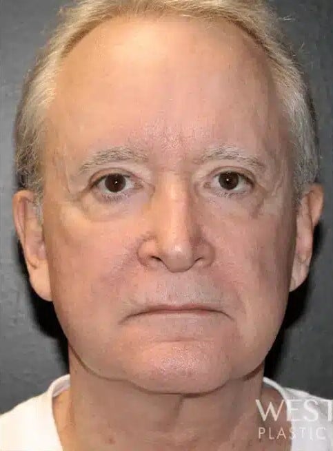 Before Image: Neck Lift - front