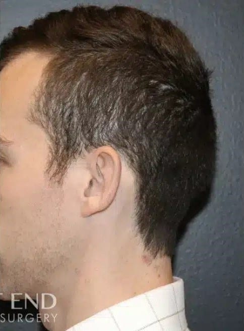 After Image: Otoplasty - left-side